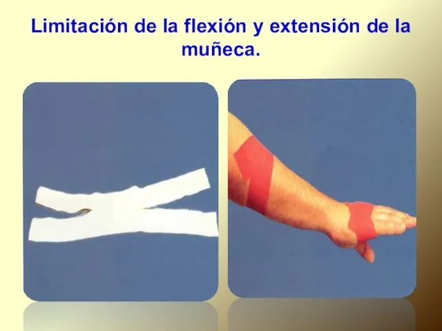 Limitación de la flexión y extensión de la muñeca.