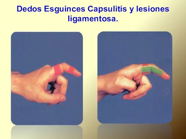 Dedos Esguinces Capsulitis y lesiones ligamentosa.