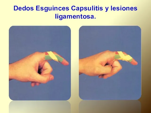 Dedos Esguinces Capsulitis y lesiones ligamentosa.