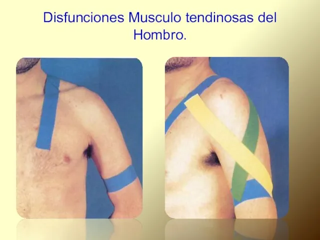 Disfunciones Musculo tendinosas del Hombro.