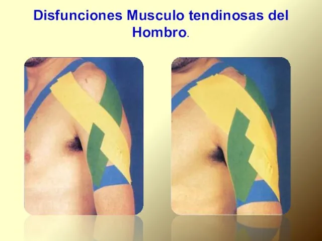 Disfunciones Musculo tendinosas del Hombro.