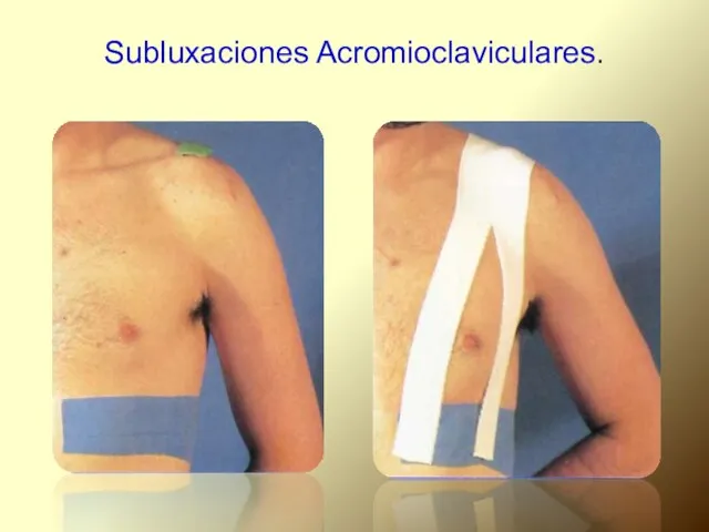 Subluxaciones Acromioclaviculares.