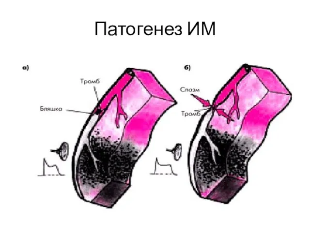 Патогенез ИМ