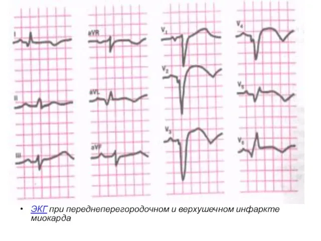 ЭКГ при переднеперегородочном и верхушечном ин­фаркте миокарда