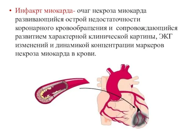 Инфакрт миокарда- очаг некроза миокарда развивающийся острой недостаточности коронарного кровообращения