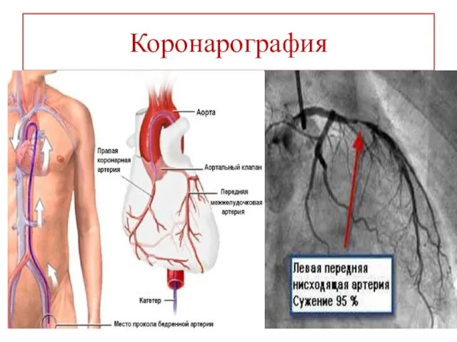 Коронарография