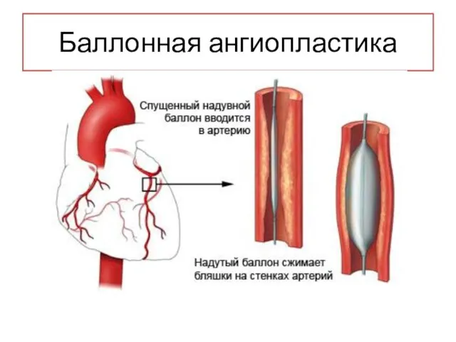 Баллонная ангиопластика