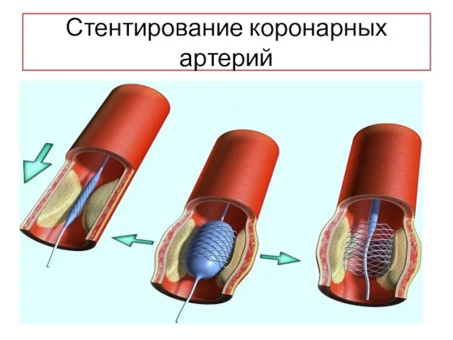 Стентирование коронарных артерий