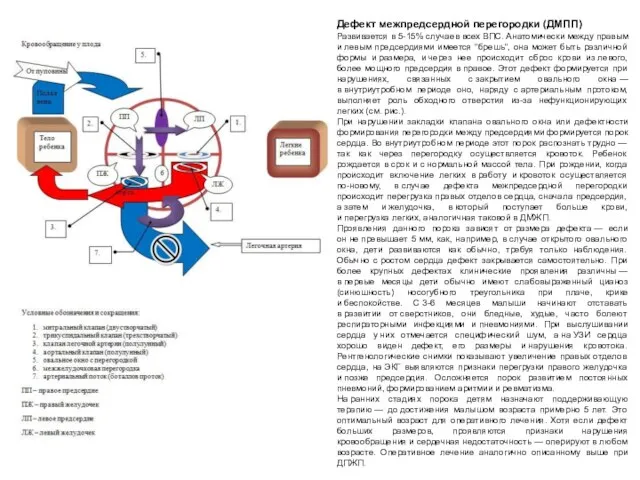 Дефект межпредсердной перегородки (ДМПП) Развивается в 5-15% случаев всех ВПС.