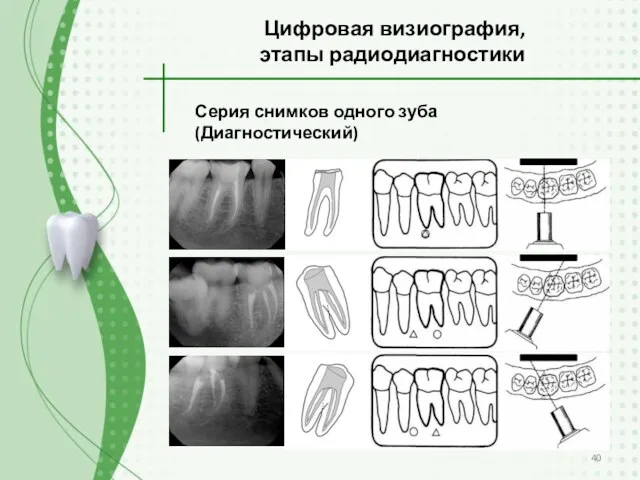 Серия снимков одного зуба (Диагностический) Цифровая визиография, этапы радиодиагностики