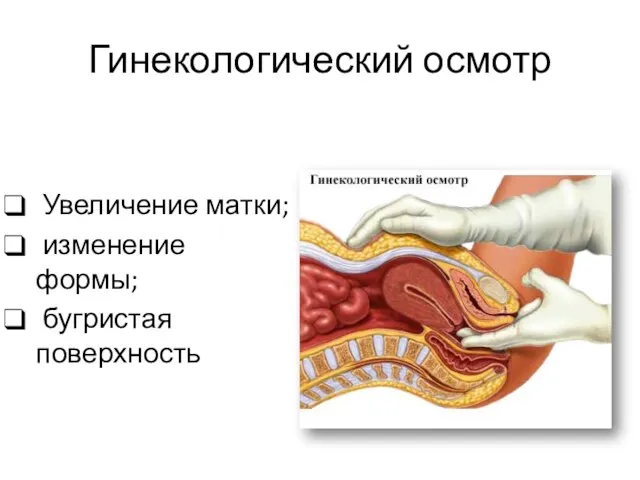 Гинекологический осмотр Увеличение матки; изменение формы; бугристая поверхность