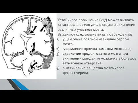 Устойчивое повышение ВЧД может вызвать катастрофическую дислокацию и вклинение различных участков мозга. Выделяют