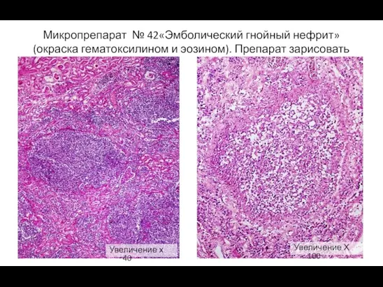 Микропрепарат № 42«Эмболический гнойный нефрит» (окраска гематоксилином и эозином). Препарат