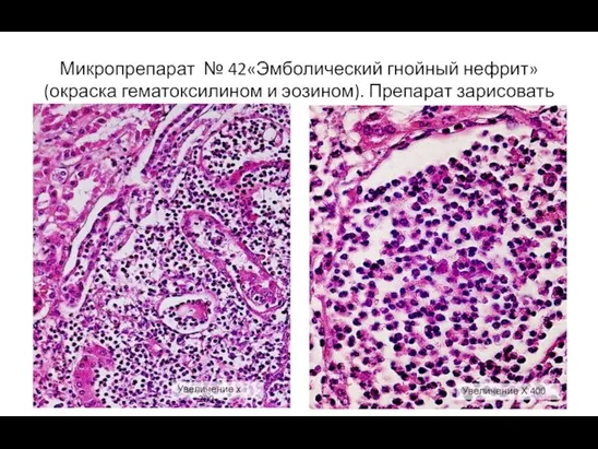 Микропрепарат № 42«Эмболический гнойный нефрит» (окраска гематоксилином и эозином). Препарат