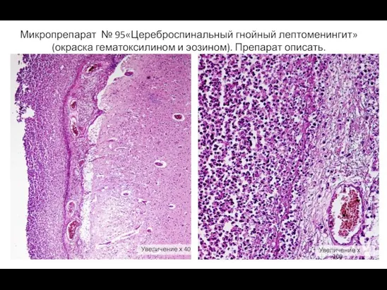 Микропрепарат № 95«Цереброспинальный гнойный лептоменингит» (окраска гематоксилином и эозином). Препарат