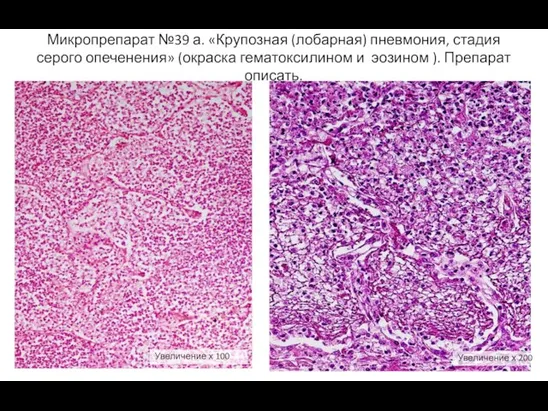 Микропрепарат №39 а. «Крупозная (лобарная) пневмония, стадия серого опеченения» (окраска