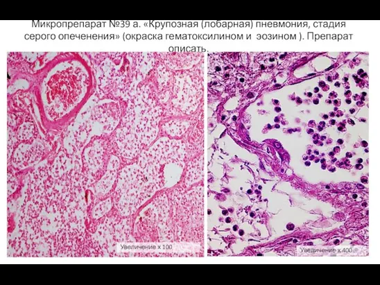 Микропрепарат №39 а. «Крупозная (лобарная) пневмония, стадия серого опеченения» (окраска