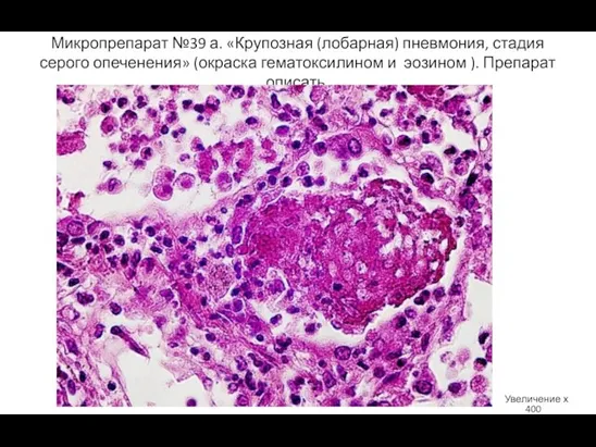 Микропрепарат №39 а. «Крупозная (лобарная) пневмония, стадия серого опеченения» (окраска