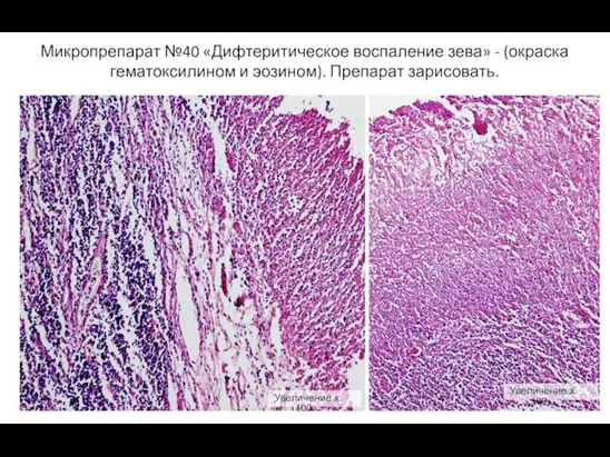 Микропрепарат №40 «Дифтеритическое воспаление зева» - (окраска гематоксилином и эозином).