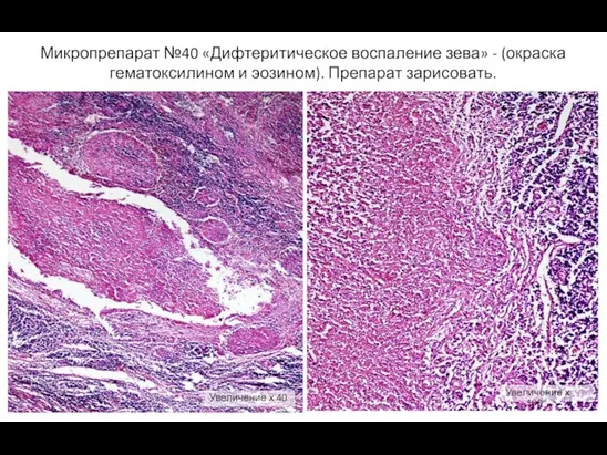 Микропрепарат №40 «Дифтеритическое воспаление зева» - (окраска гематоксилином и эозином).