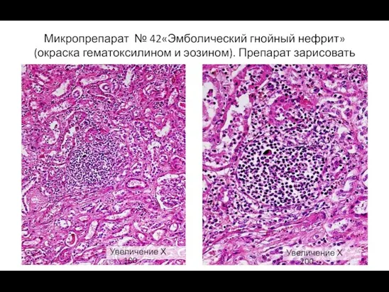 Микропрепарат № 42«Эмболический гнойный нефрит» (окраска гематоксилином и эозином). Препарат
