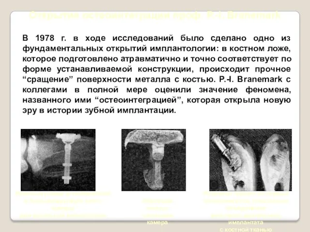 Открытие остеоинтеграции проф. P.-I. Branemark В 1978 г. в ходе