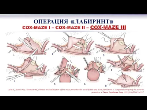 ОПЕРАЦИЯ «ЛАБИРИНТ» COX-MAZE I – COX-MAZE II – COX-MAZE III