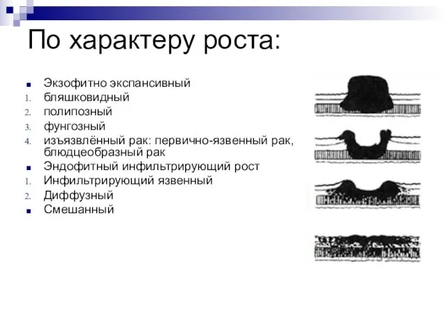 Экзофитно экспансивный бляшковидный полипозный фунгозный изъязвлённый рак: первично-язвенный рак, блюдцеобразный