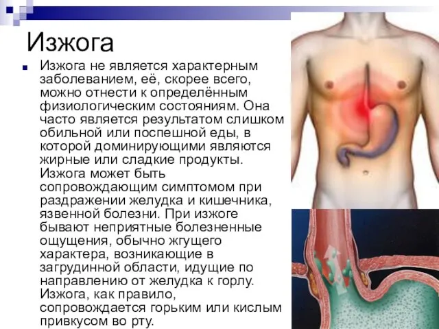 Изжога Изжога не является характерным заболеванием, её, скорее всего, можно