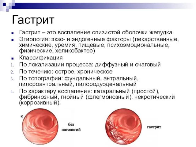 Гастрит Гастрит – это воспаление слизистой оболочки желудка Этиология: экзо-