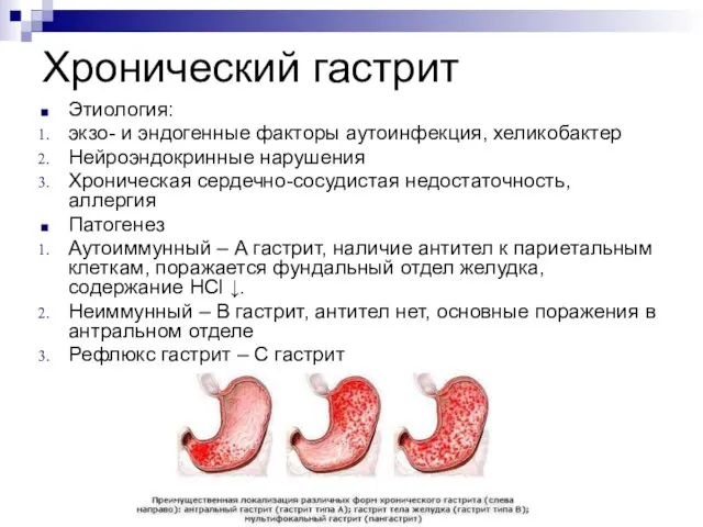 Хронический гастрит Этиология: экзо- и эндогенные факторы аутоинфекция, хеликобактер Нейроэндокринные