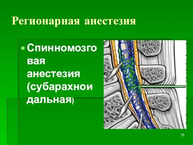 Регионарная анестезия Спинномозговая анестезия (субарахноидальная)