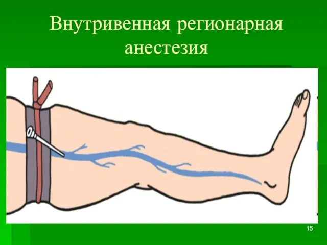 Внутривенная регионарная анестезия