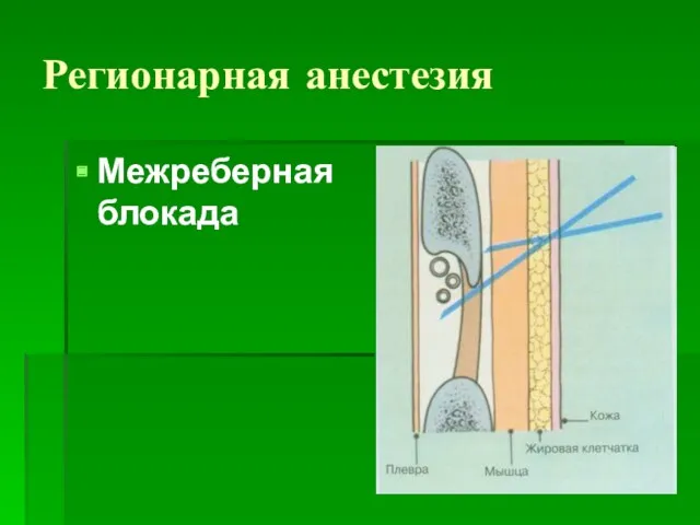 Регионарная анестезия Межреберная блокада