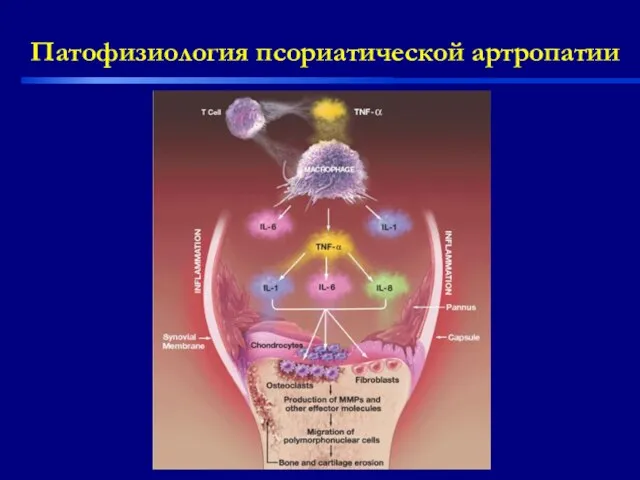 Патофизиология псориатической артропатии