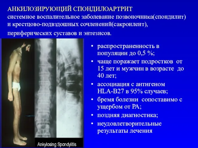 АНКИЛОЗИРУЮЩИЙ СПОНДИЛОАРТРИТ системное воспалительное заболевание позвоночника(спондилит) и крестцово-подвздошных сочленений(сакроилеит), периферических