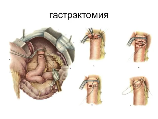 гастрэктомия