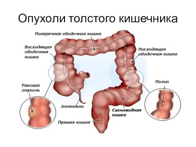 Опухоли толстого кишечника