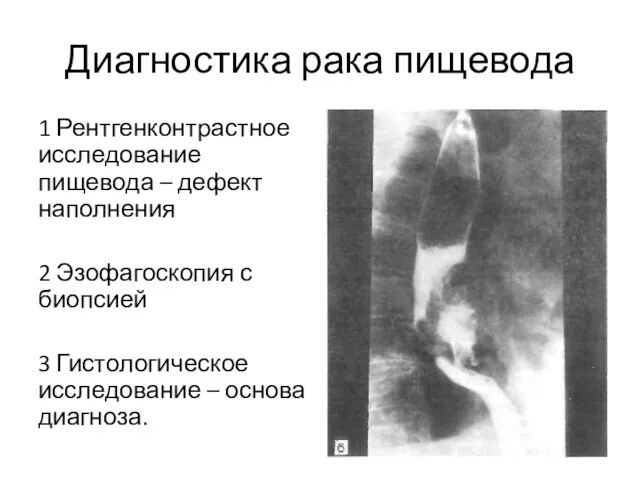 Диагностика рака пищевода 1 Рентгенконтрастное исследование пищевода – дефект наполнения