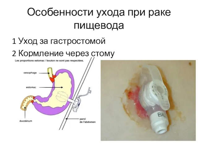 Особенности ухода при раке пищевода 1 Уход за гастростомой 2 Кормление через стому