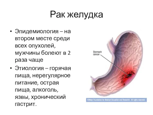 Рак желудка Эпидемиология – на втором месте среди всех опухолей,