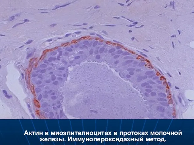 Актин в миоэпителиоцитах в протоках молочной железы. Иммунопероксидазный метод.