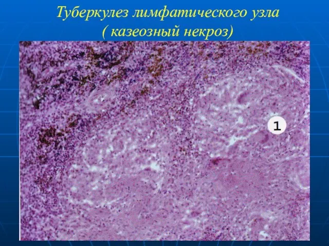 Туберкулез лимфатического узла ( казеозный некроз)
