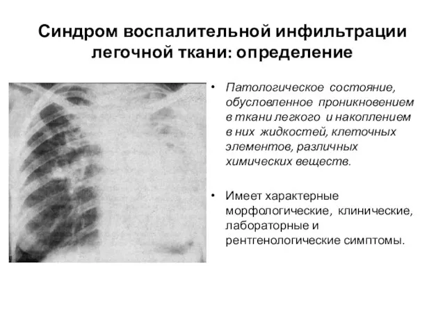 Синдром воспалительной инфильтрации легочной ткани: определение Патологическое состояние, обусловленное проникновением