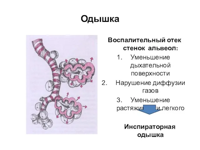 Одышка Воспалительный отек стенок альвеол: Уменьшение дыхательной поверхности Нарушение диффузии газов Уменьшение растяжимости легкого Инспираторная одышка