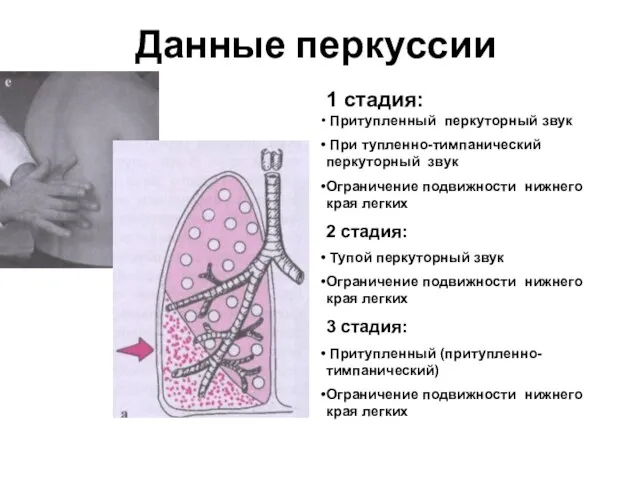 Данные перкуссии Притупленный перкуторный звук При тупленно-тимпанический перкуторный звук Ограничение