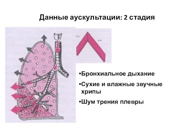 Данные аускультации: 2 стадия Бронхиальное дыхание Сухие и влажные звучные хрипы Шум трения плевры