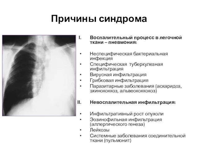 Причины синдрома Воспалительный процесс в легочной ткани – пневмония: Неспецифическая бактериальная инфекция Специфическая