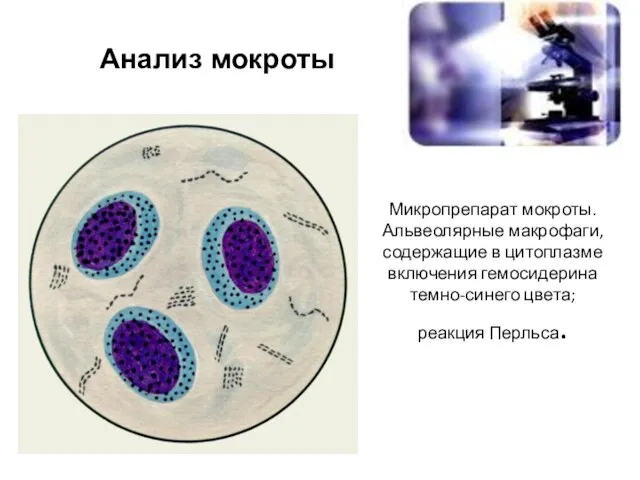 Микропрепарат мокроты. Альвеолярные макрофаги, содержащие в цитоплазме включения гемосидерина темно-синего цвета; реакция Перльса. Анализ мокроты