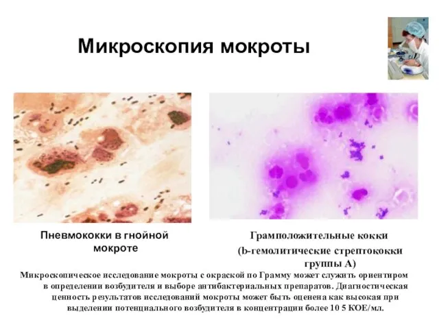 Микроскопия мокроты Пневмококки в гнойной мокроте Грамположительные кокки (b-гемолитические стрептококки группы А) Микроскопическое